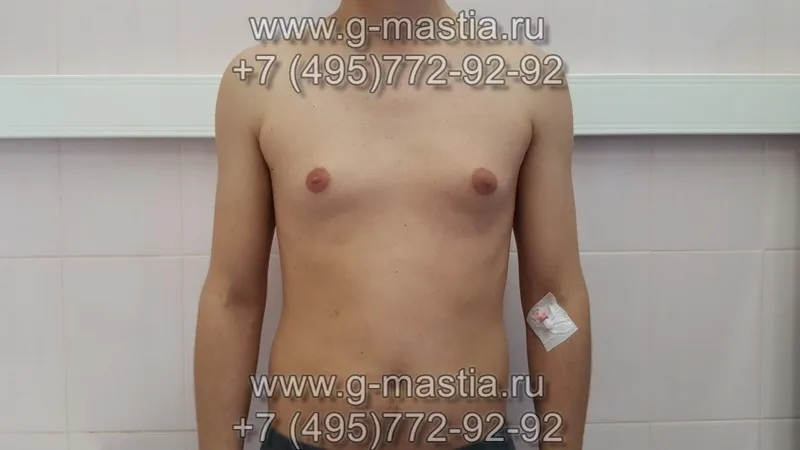 Гинекомастия у подростка. Результат операции