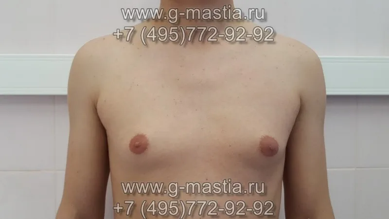 Увеличенные грудные железы и жировая ткань в области груди