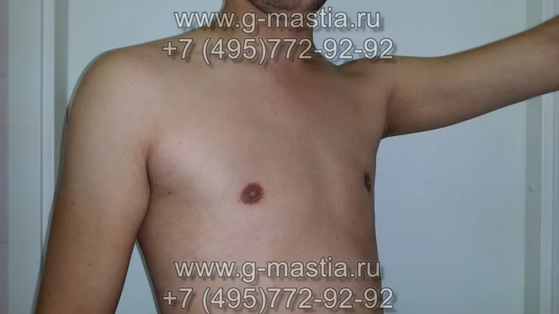 Результат операции по удалению гинекомастии через 1 месяц