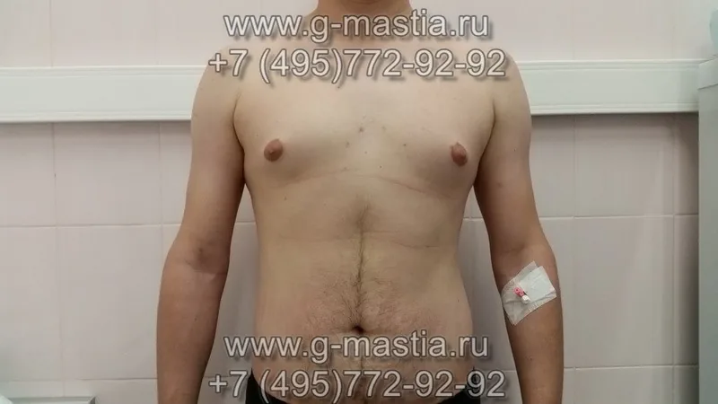 Увеличение груди у мужчин - гинекомастия