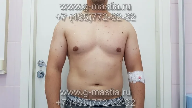 Удаление гинекомастии и липосакция живота. Результат через 1,5 месяца