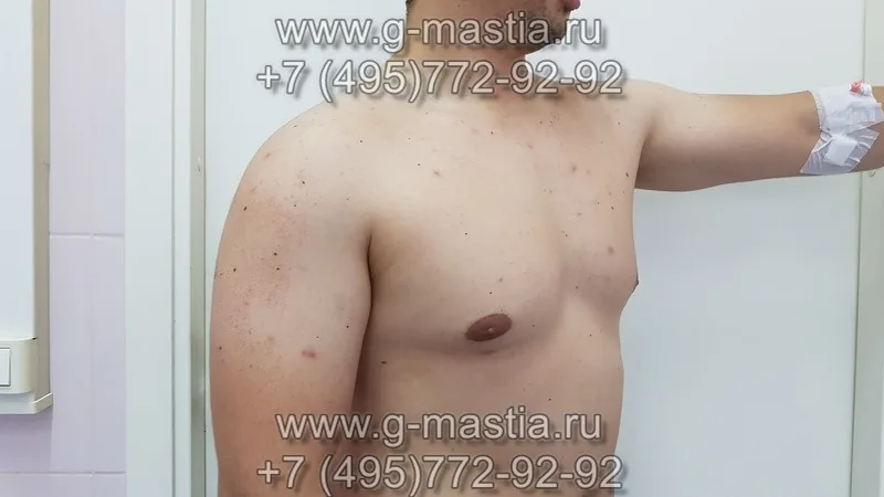 Гинекомастия смешанной формы