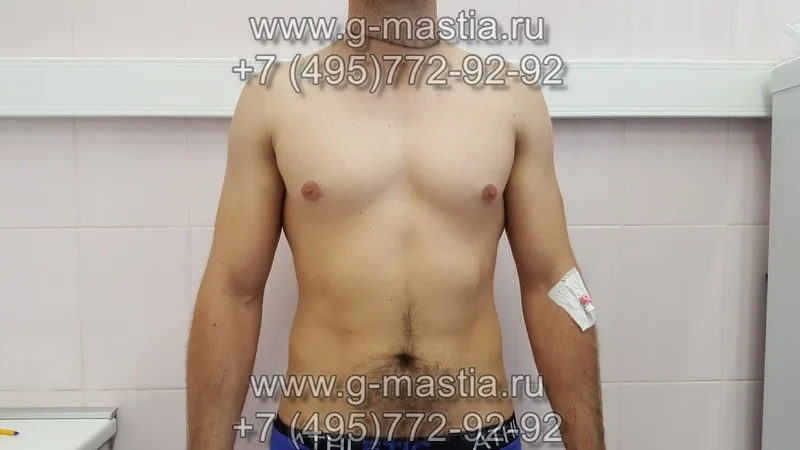 Удаление истинной гинекомастии - подкожная мастэктомия
