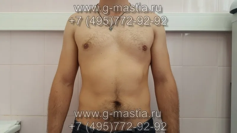 Результат через месяц после операции