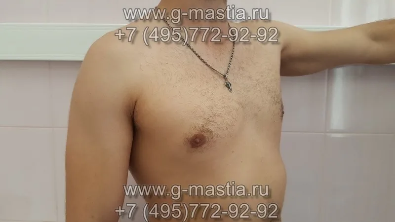 Результат через месяц после операции