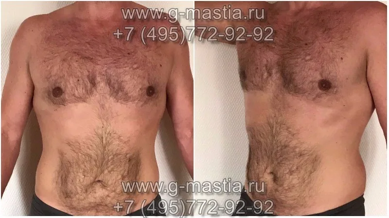 Результат операции через 4 месяца