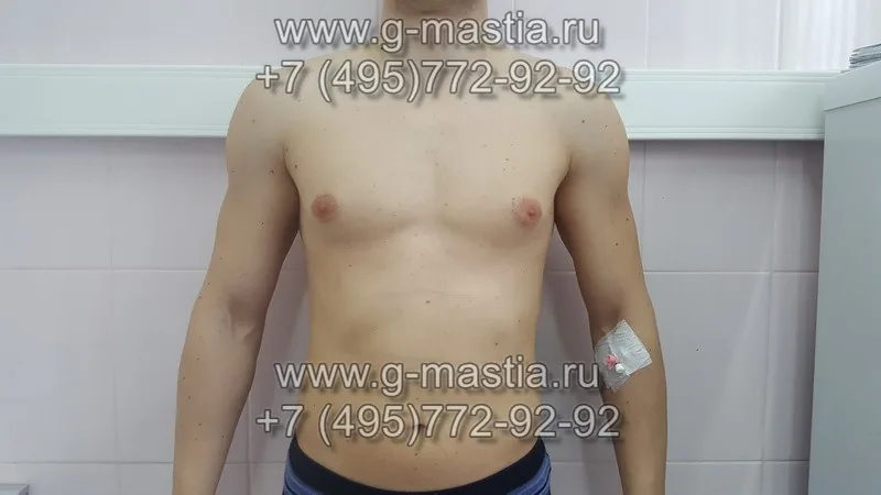 Истинная гинекомастия у мужчин