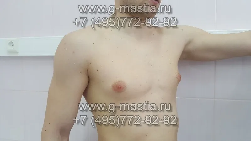 Истинная гинекомастия до операции