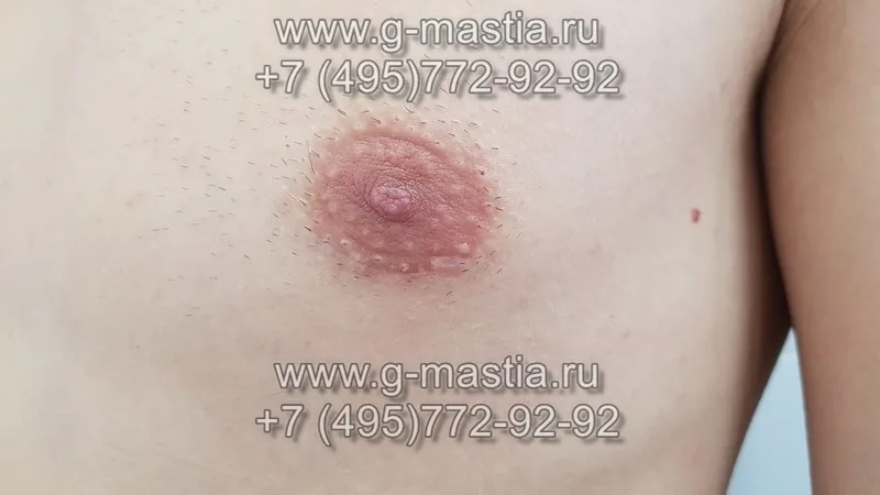Результат операции через 1,5 месяца