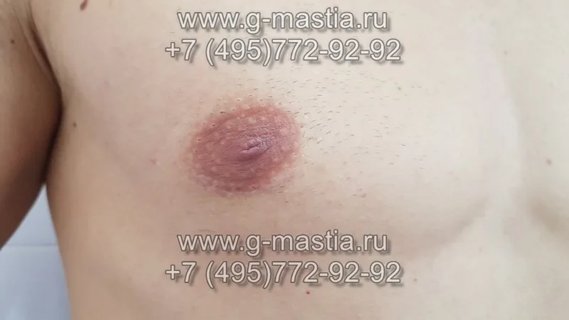 Результат операции через 1,5 месяца