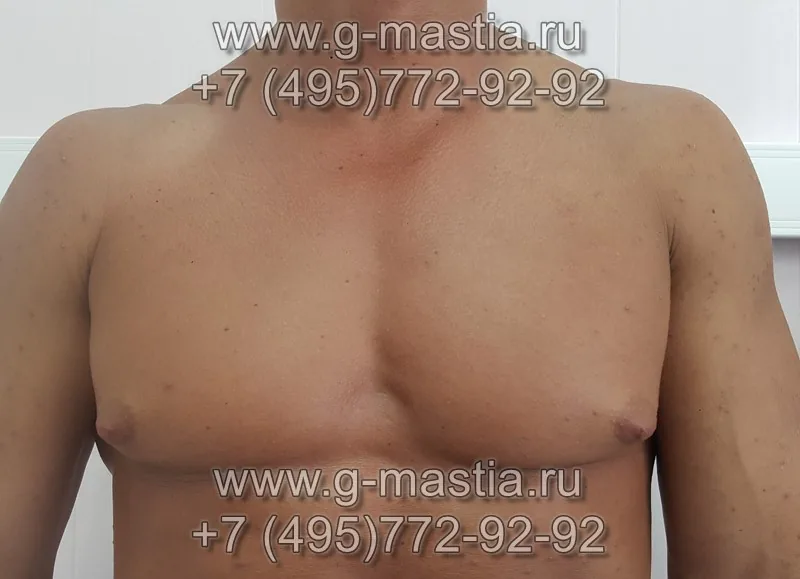 Гинекомастия у бодибилдера