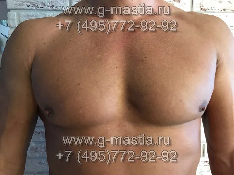 Через месяц после удаления гинекомастии