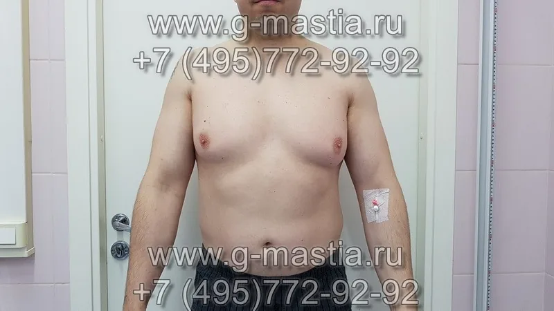 Гинекомастия у мужчин. Как лечить?