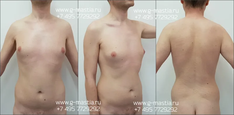 Липосакция боков и груди у мужчин. Результат через 1 месяц