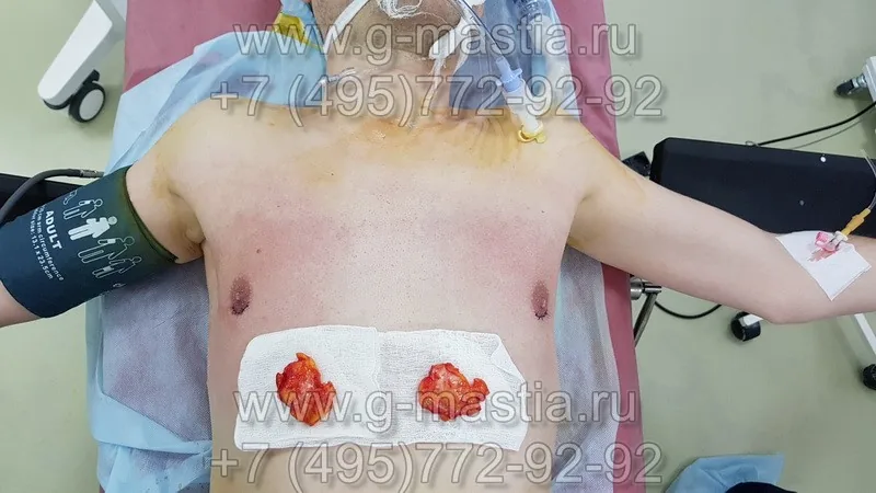 Удалённые грудные железы