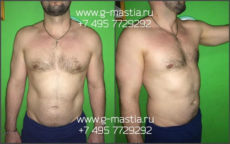Результат удаления гинекомастии