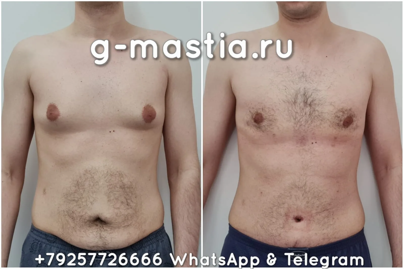 Абдоминопластика и гинекомастия