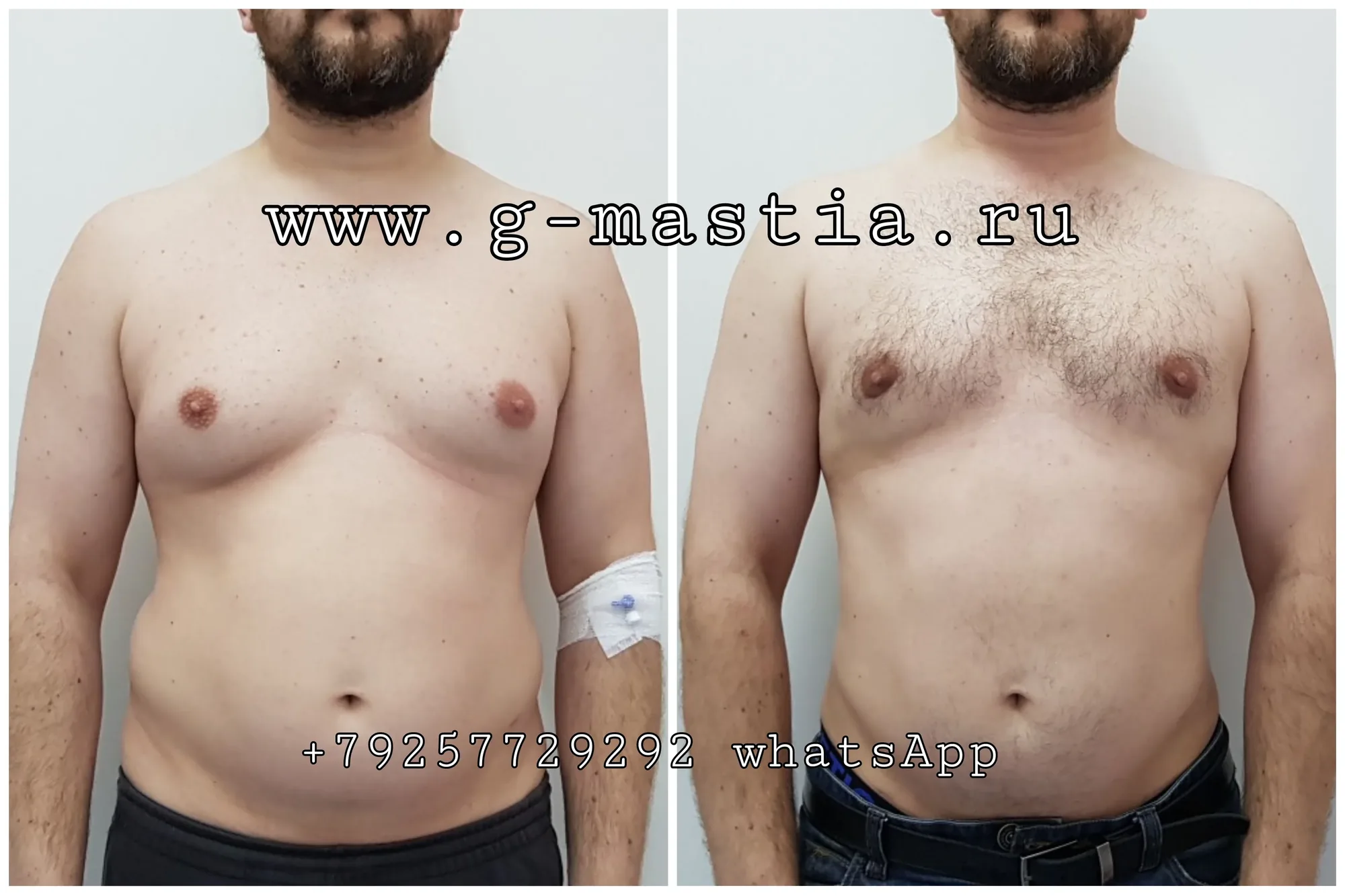Удаление гинекомастии и липосакция у мужчин