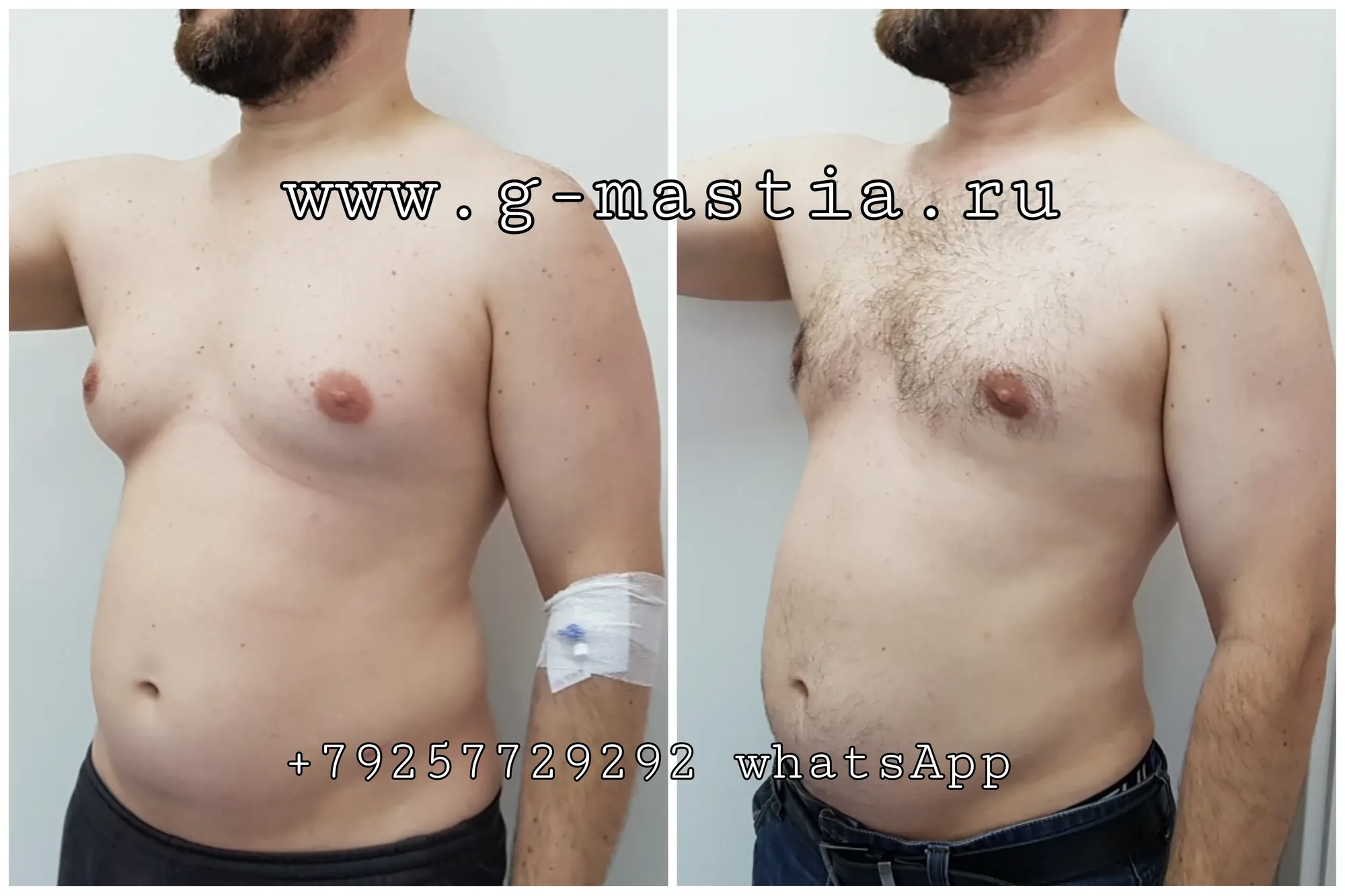 Через 2 месяца после удаления гинекомастии и липосакции