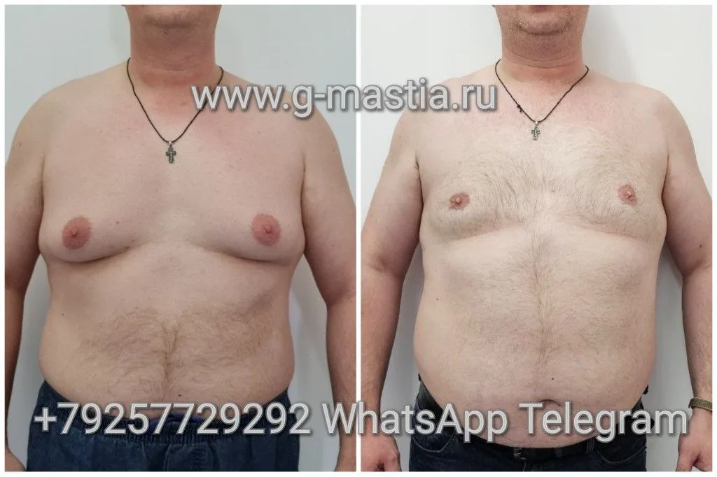 Большая гинекомастия
