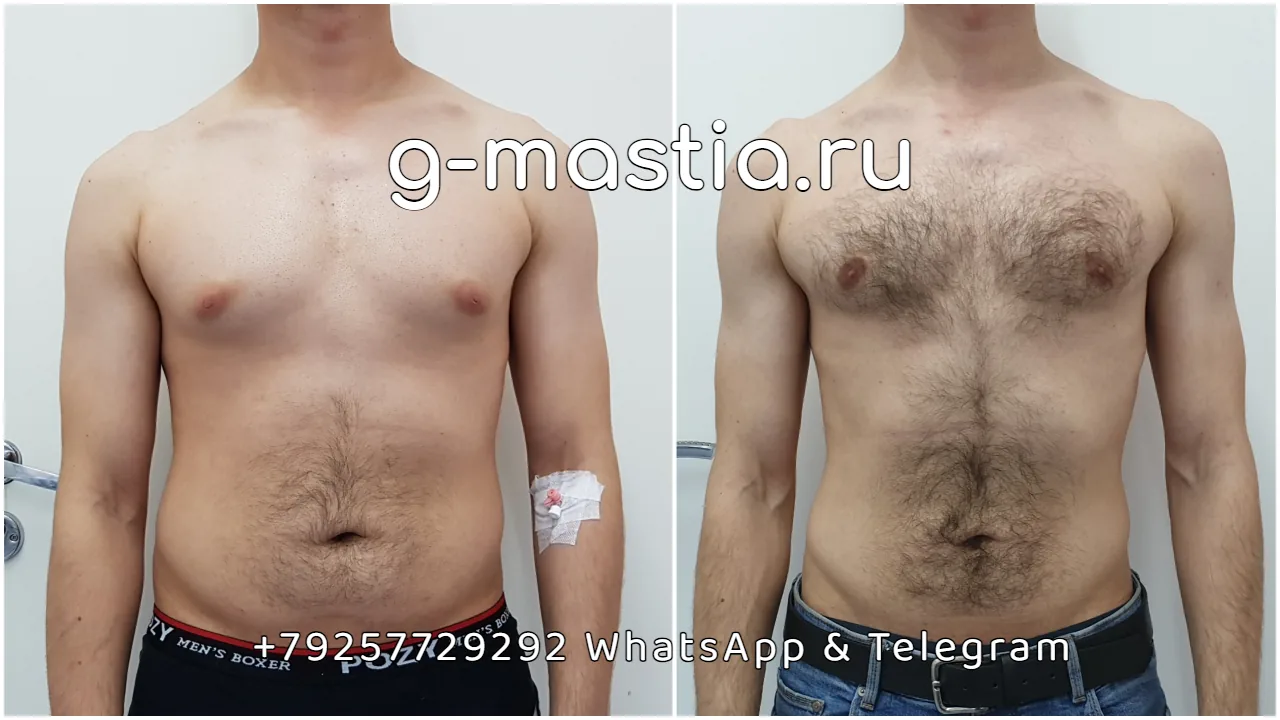 Способы лечения гинекомастии