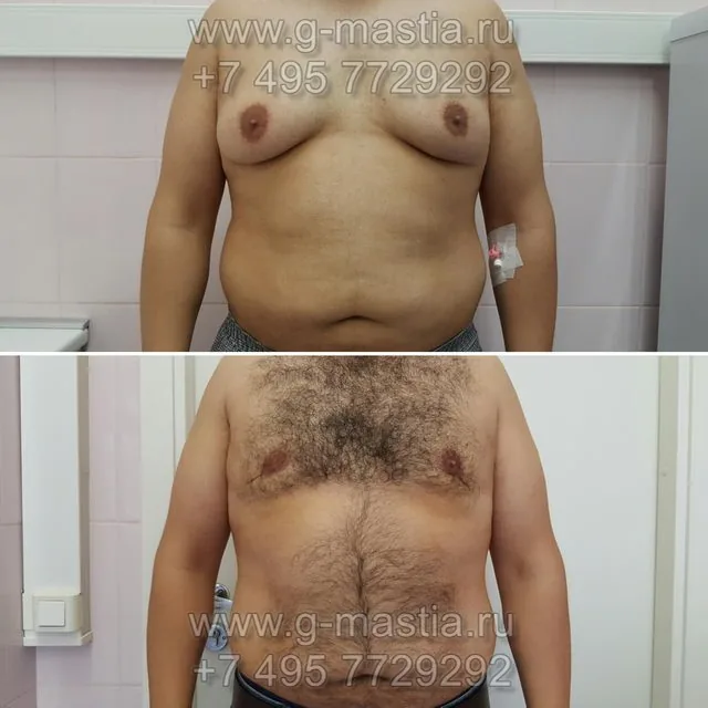 Пластика груди у мужчины с ожирением и выраженной липомастией