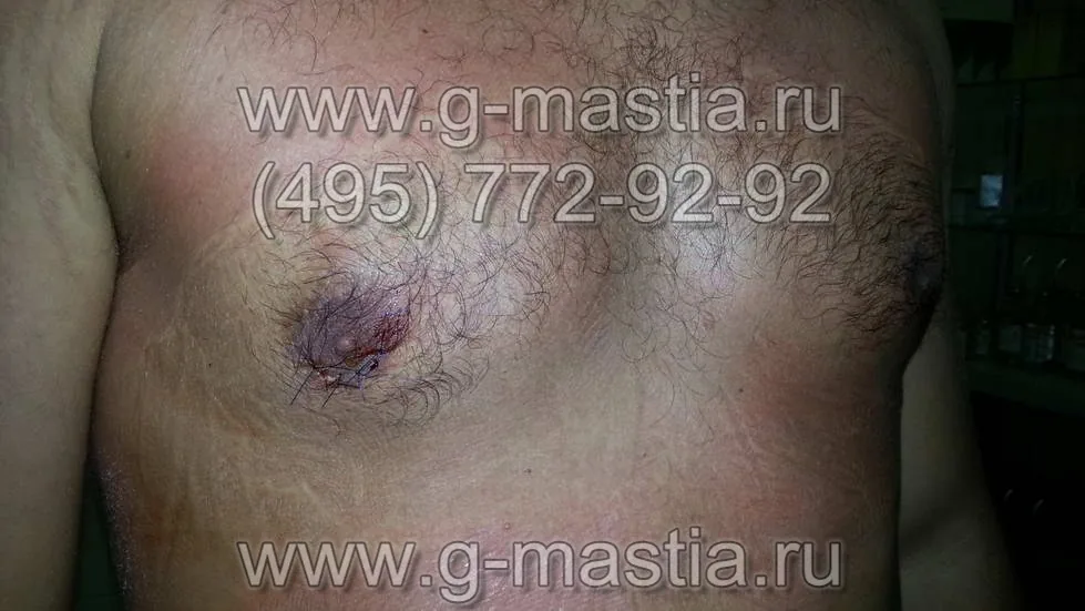 Разрез по нижней трети ареолы соска, ушит отдельными узловыми швами