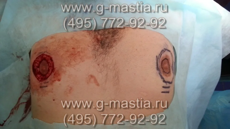 Пациент на операционном столе. Правый сосок почти сформирован, на левом - разметка, сделанная до операции