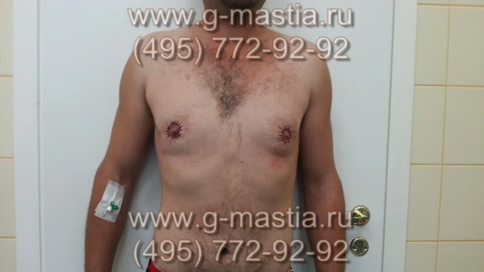 Пациент на следующий день после операции. Соски за ночь не потемнели - значит, кровоснабжение сохранено