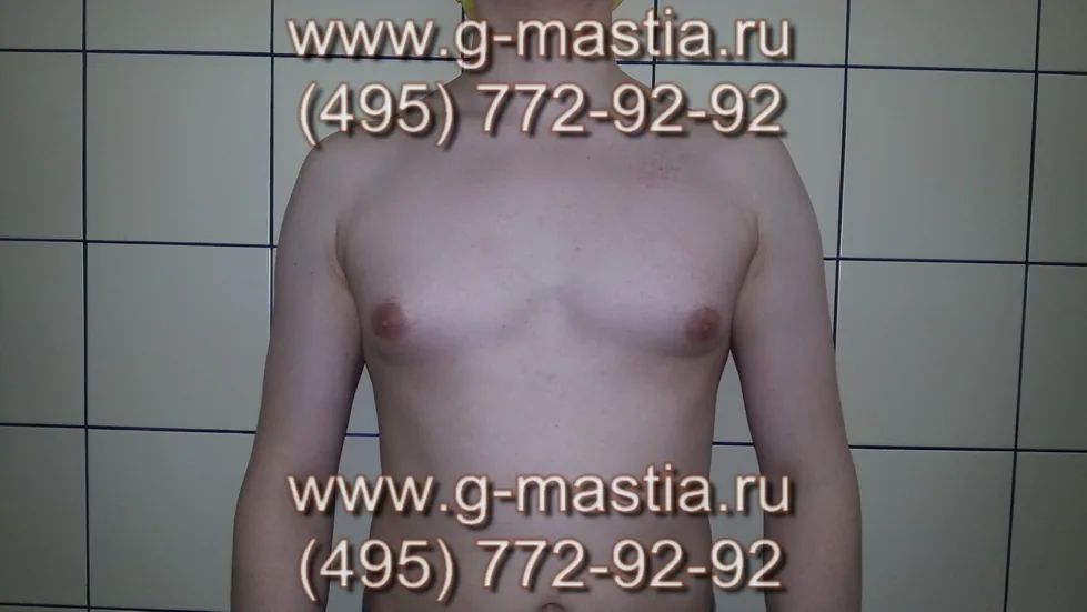 Подкожная мастэктомия с липэктомией и липомоделированием под местной анестезией при смешанной гинекомастии