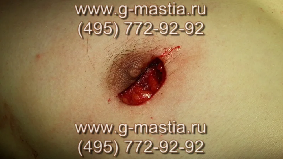 Железа справа удалена, видна грудная мышца, ареола соска проваливается