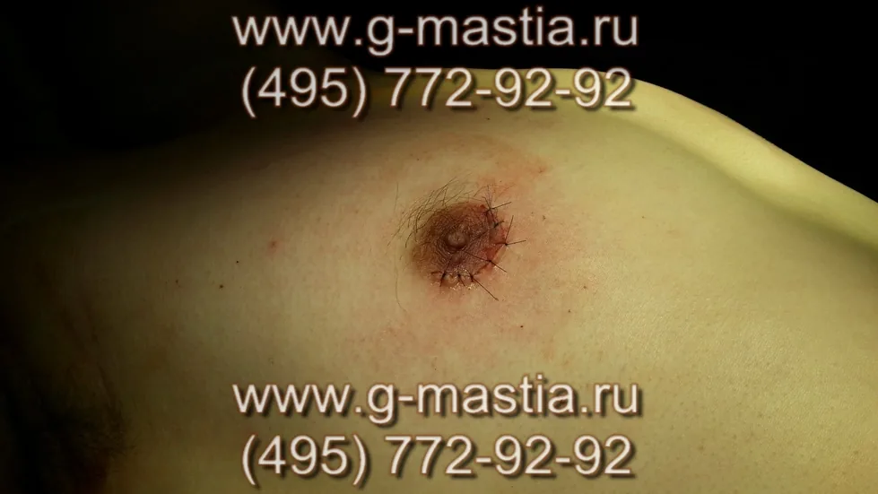 Ареола соска зашита узловыми швами