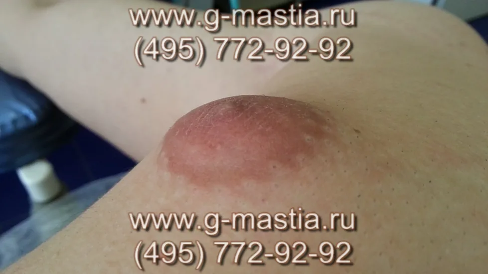 Пациент на операционном столе. Припухлость сосков связана с наличием железы под соском