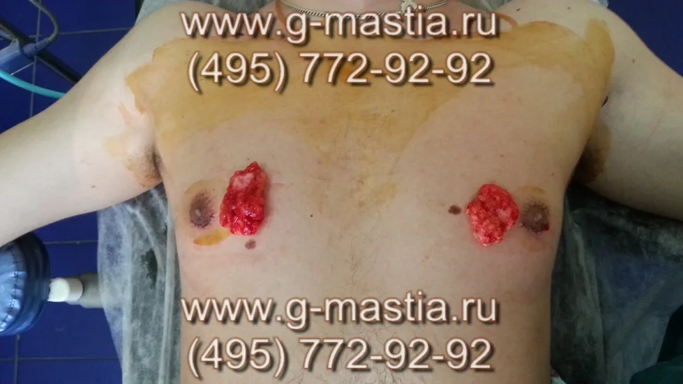 Финальное фото. Удалённые железы справа и слева