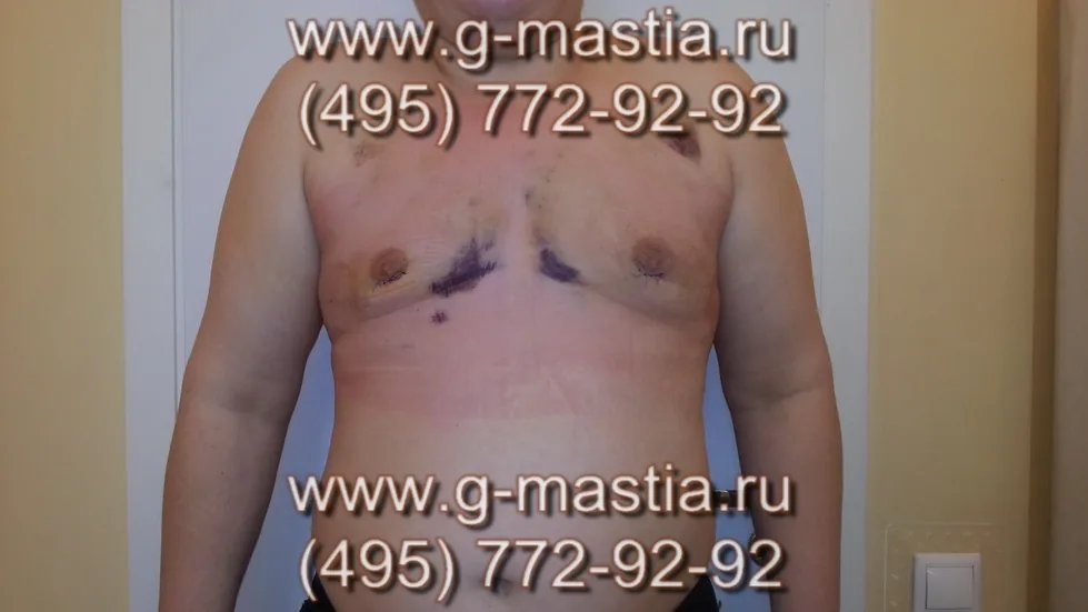 Пациент на следующий день после операции