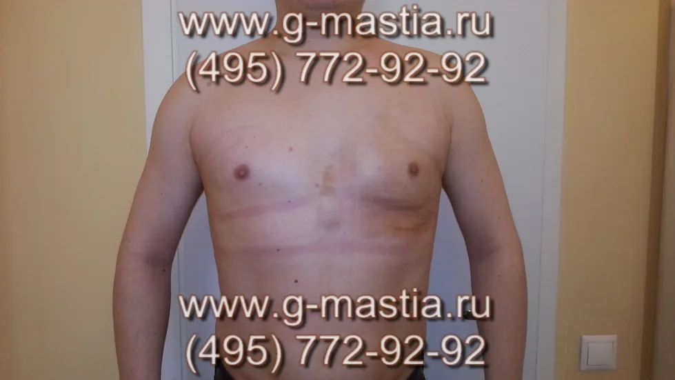 Пациент на осмотре через 3 недели. Соски симметричны, левая грудь в норме