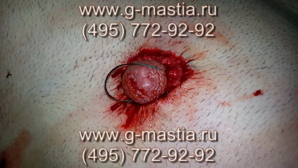 Подтяжка кожи