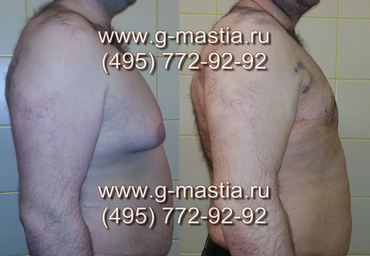 Результат через 2 дня после операции