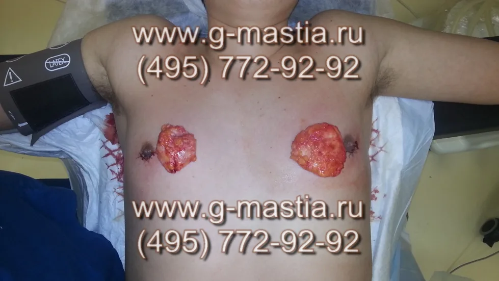 Удаленные железы
