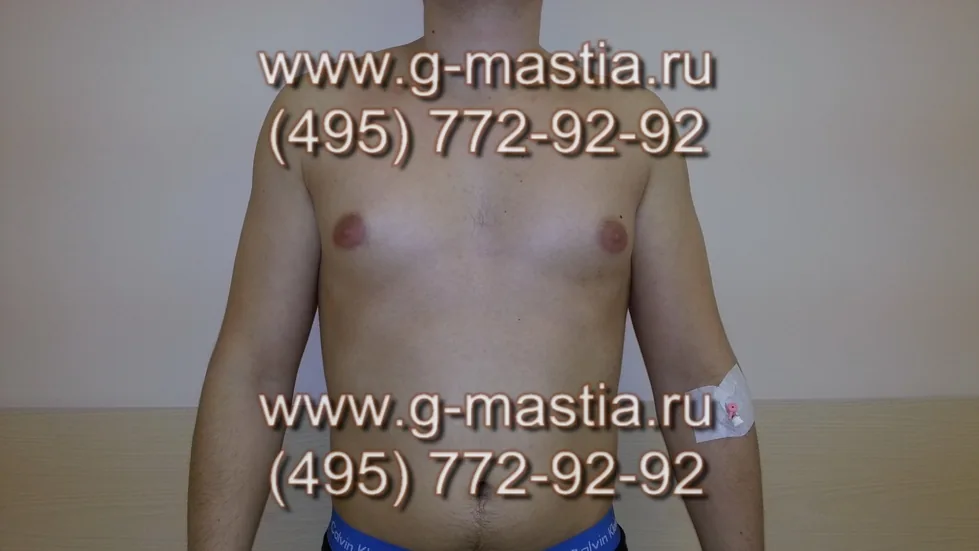 Хирургическое лечение смешанной гинекомастии