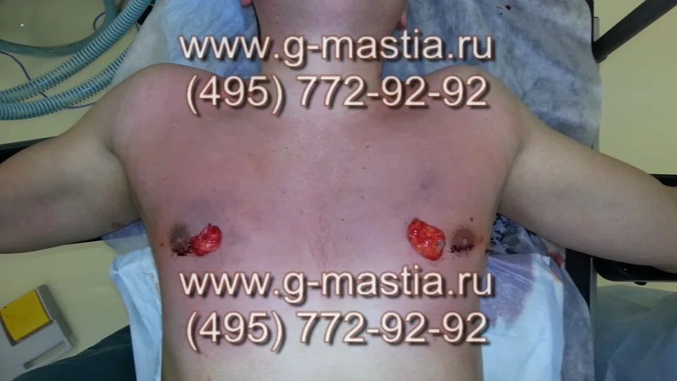 Удалённые грудные железы