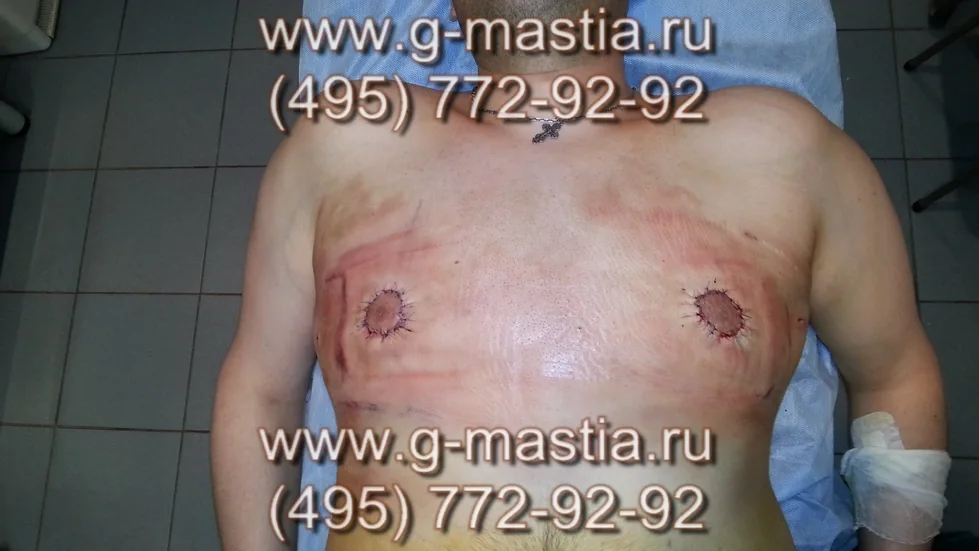Осмотр и перевязка на следующий день. Соски в норме, небольшая отёчность