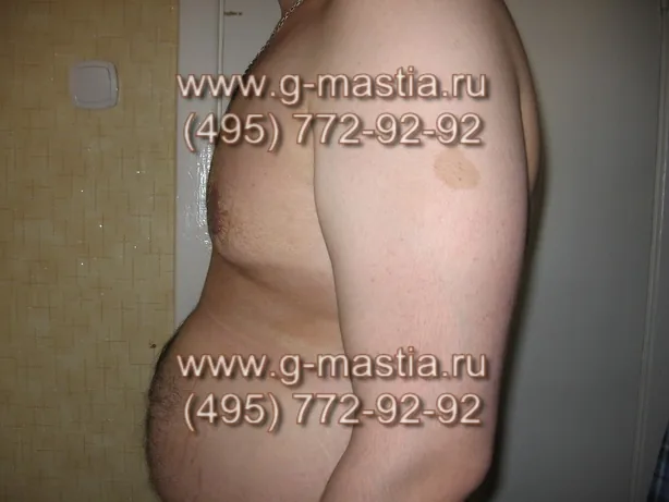 Фотография с домашней перевязки через 33 дня