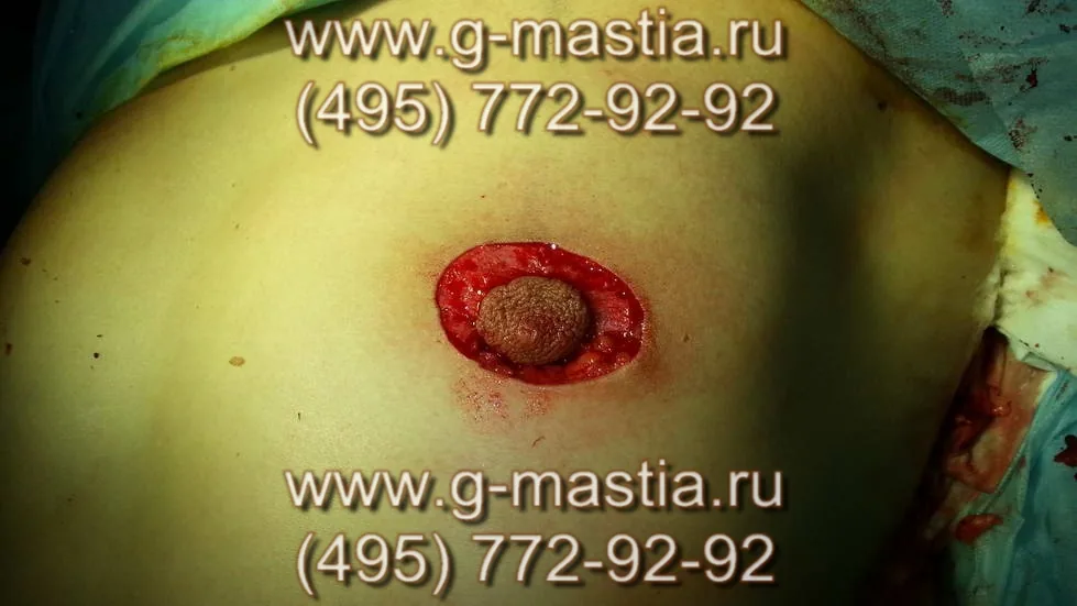 Параареолярная пексия - подтяжка кожи левой груди