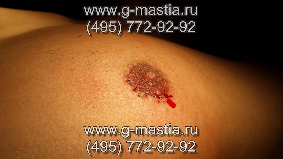 Операция по удалению гинекомастии завершена