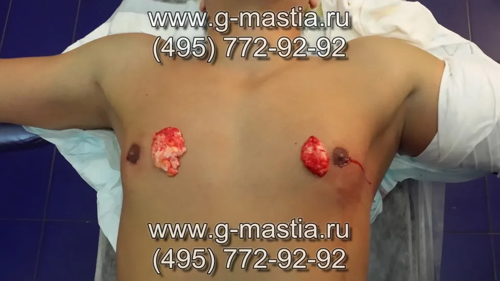 Удалённые железы при гинекомастии