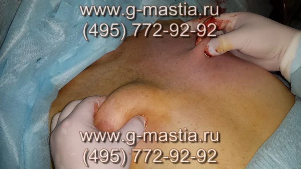 Слева проведена липосакция области груди, толщина кожной складки меньше
