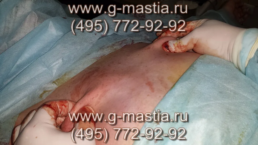 Липосакция проведена с обеих сторон, результат симметричен