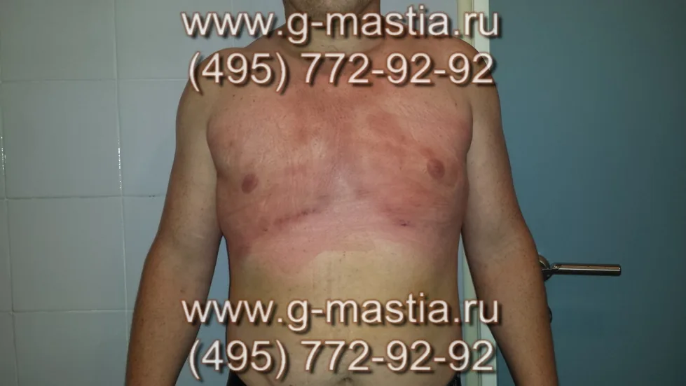 Пациент на перевязке через 2 дня после операции