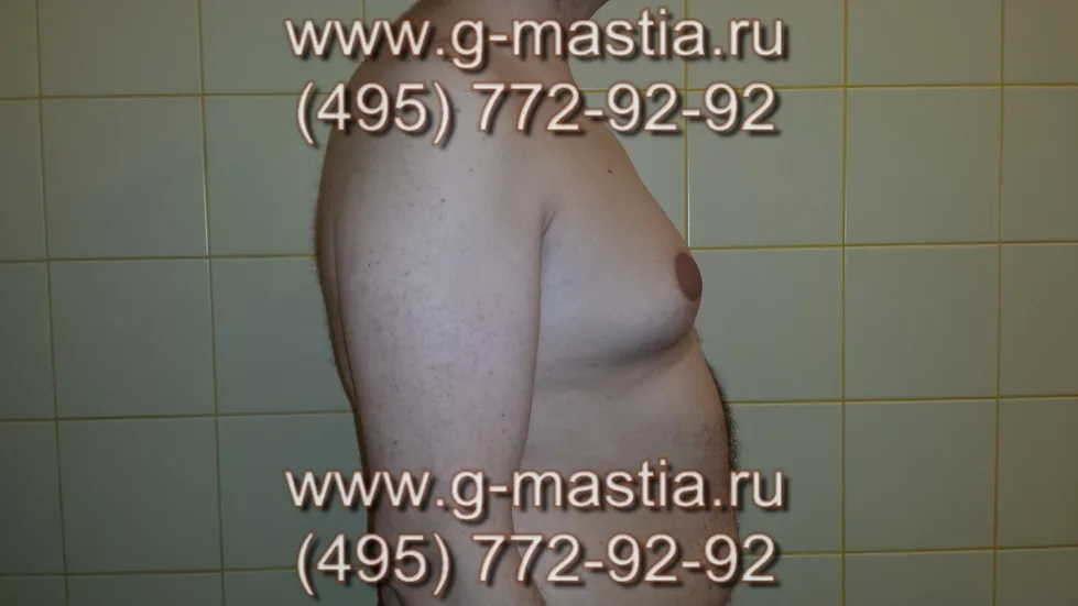 Смешанная форма гинекомастии